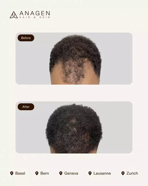 Slider image (7) Anagen - Hair Transplant Clinic in Switzerland